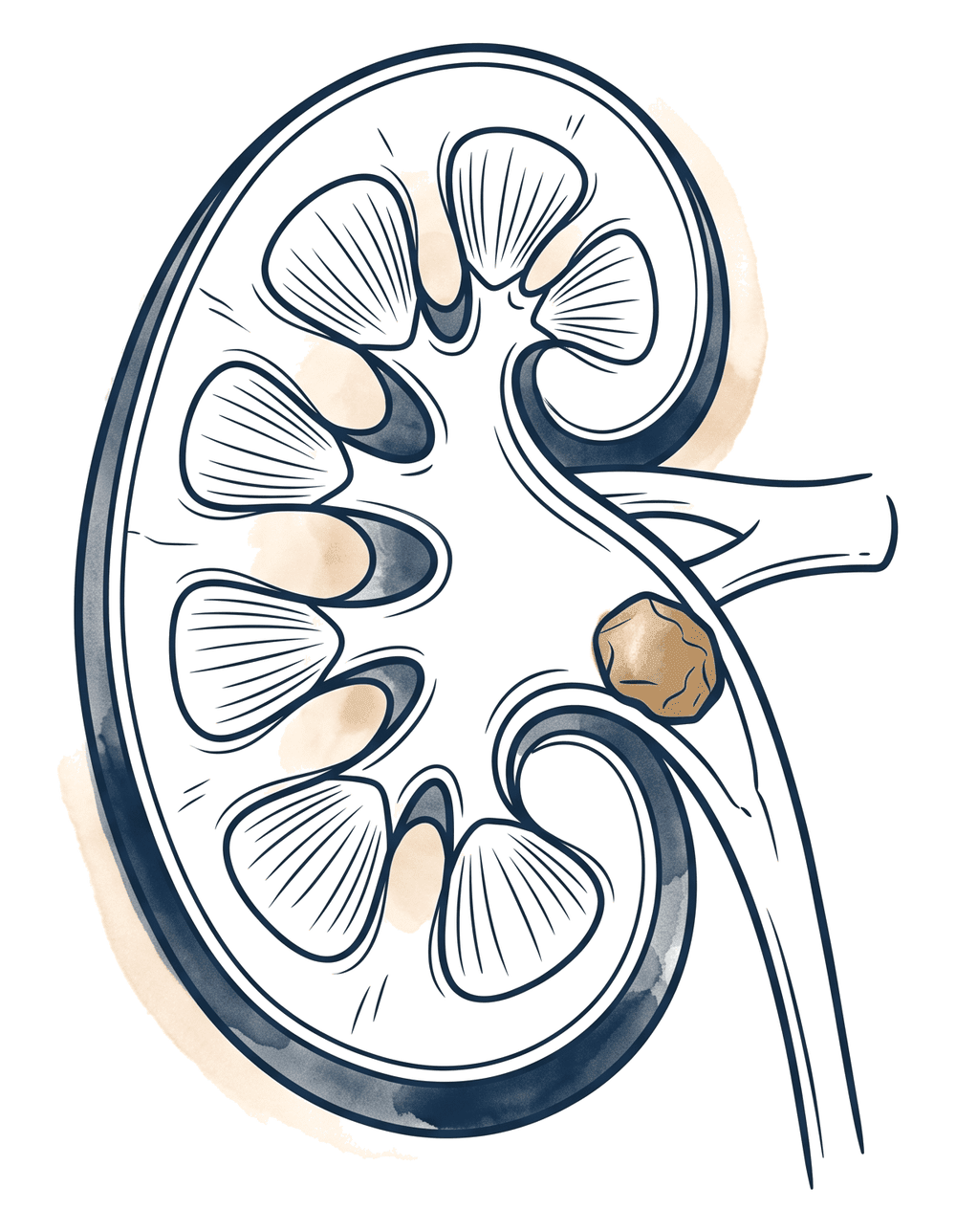 Böbrek anatomisi ve renal pelviste taş — kısmi tıkanma